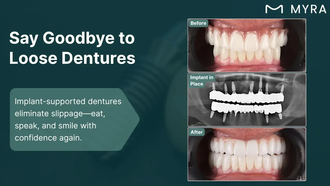 loose or-unstable-dentures.webp